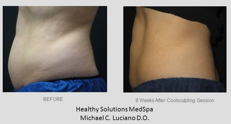Before & After Coolsculpting at Healthy Solutions Medspa
