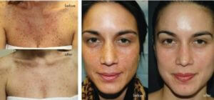 Before & After VI Peel
