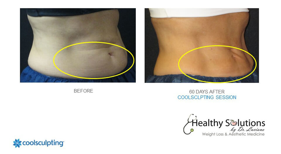 Coolsculpting Before & After Photos Coolsculpting near me doylestown pa