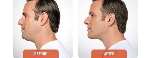 Double Chin Reduction With Kybella at Healthy Solutions Medspa