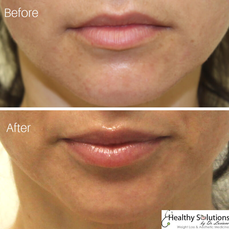 How Long Do Lip Injections Last? Juvederm Ultra, Volbella ...