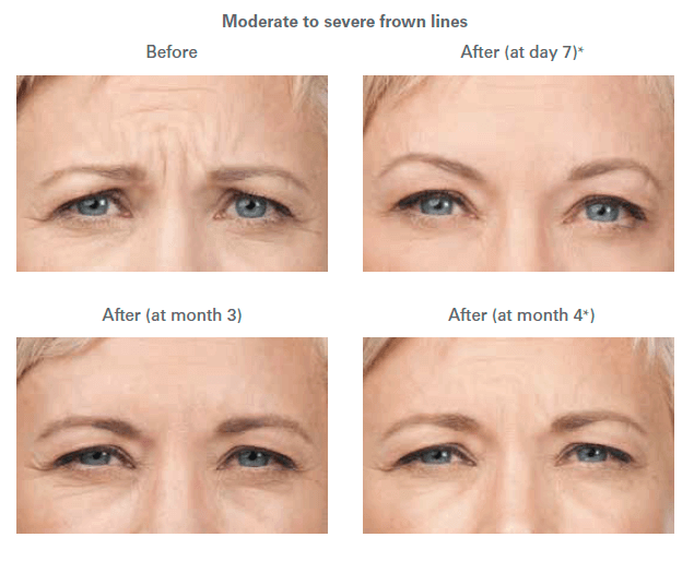 Botox before and after photos Before and After Moderate to severe frown lines